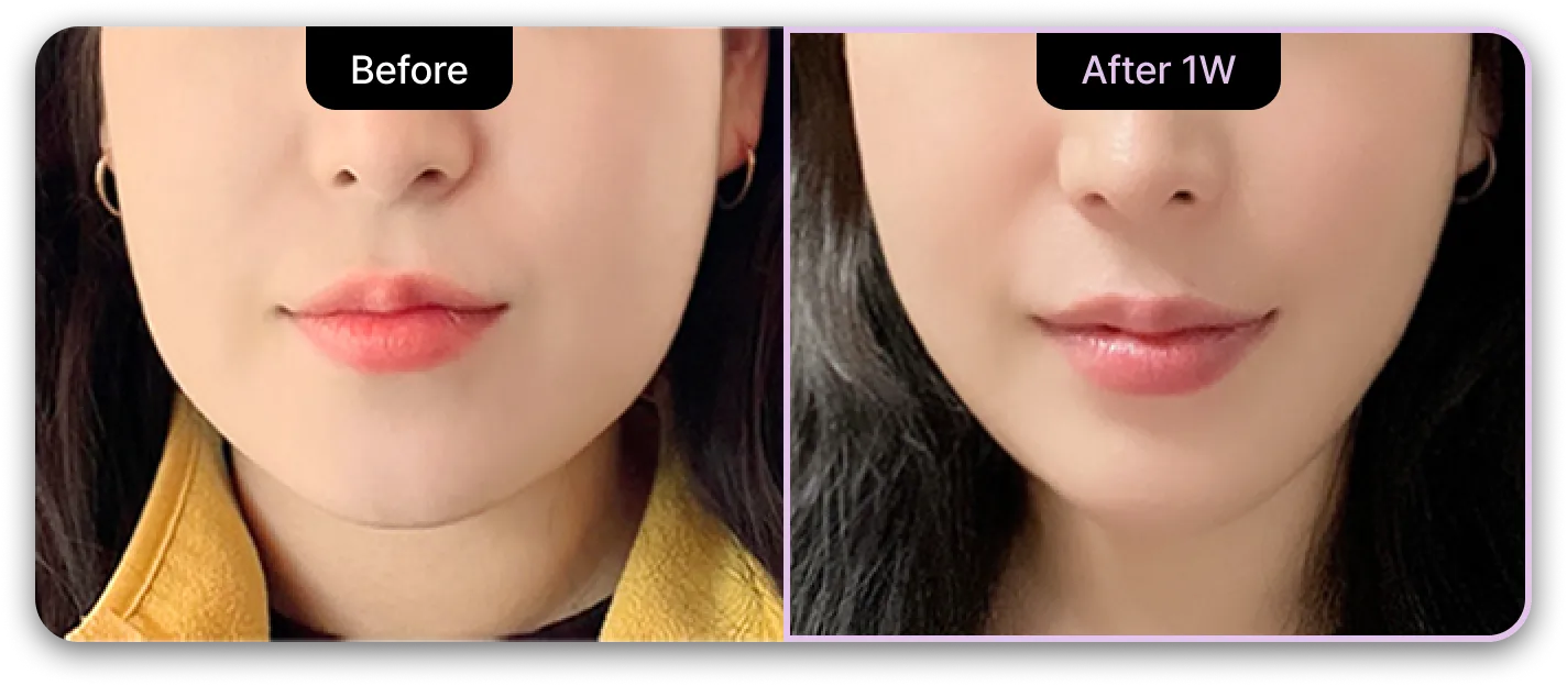 기린성형외과 4세대 갸름주사 Before & After 01