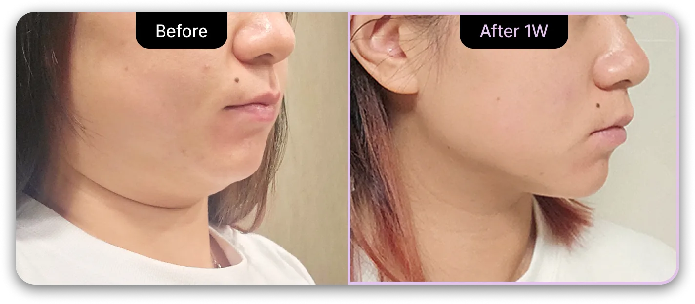 기린성형외과 4세대 갸름주사 Before & After 02