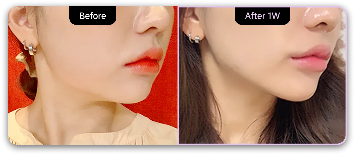 기린성형외과 4세대 갸름주사 Before & After 03