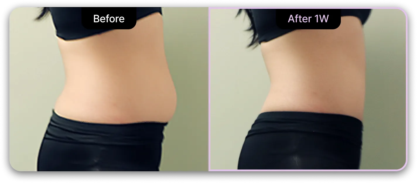 기린성형외과 4세대 갸름주사 Before & After 04
