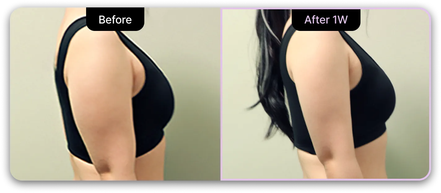 기린성형외과 4세대 갸름주사 Before & After 05