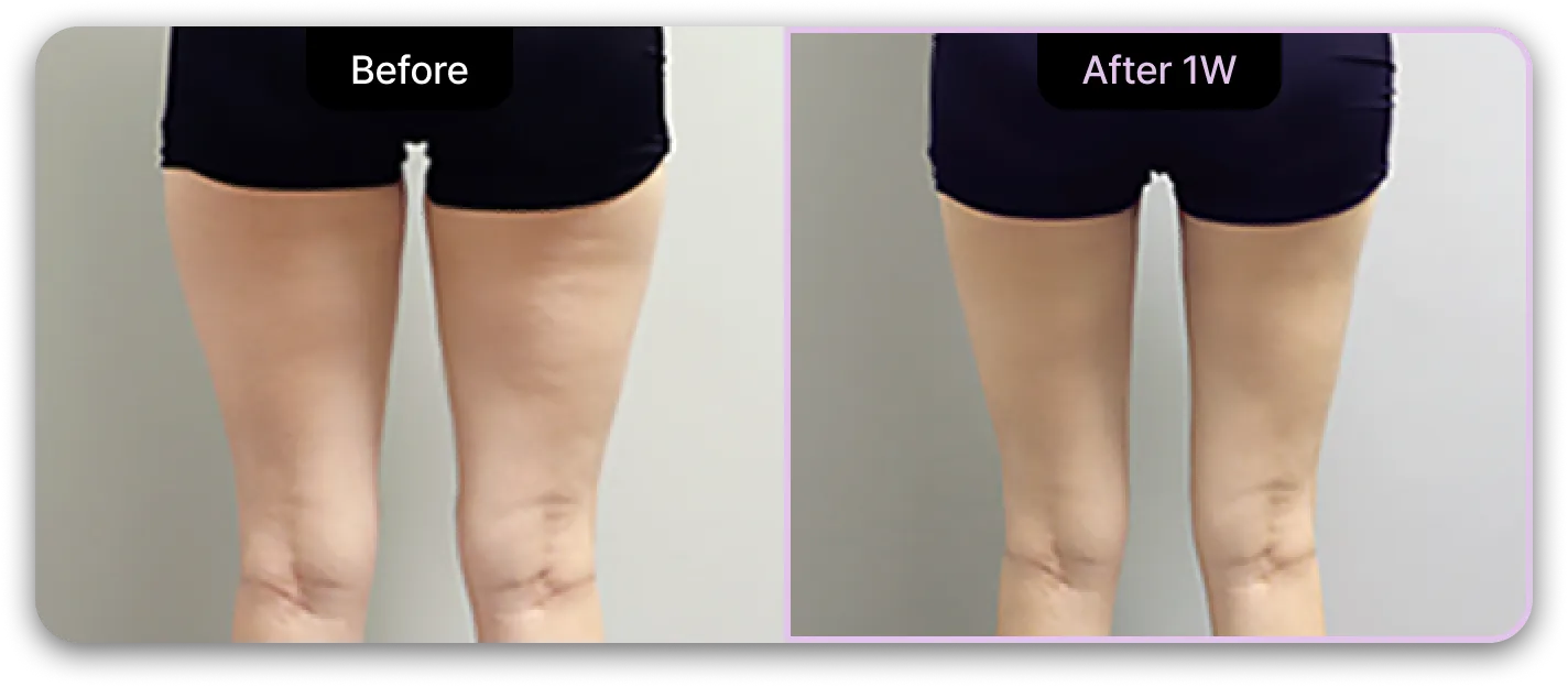 기린성형외과 4세대 갸름주사 Before & After 06