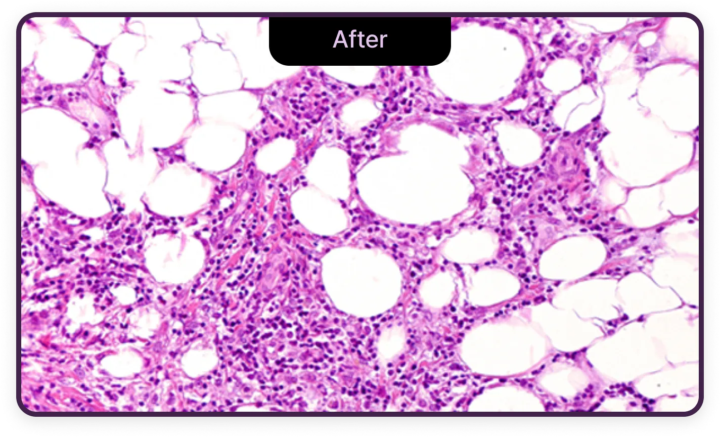 기린성형외과 4세대 갸름주사 지방세포 크기 After