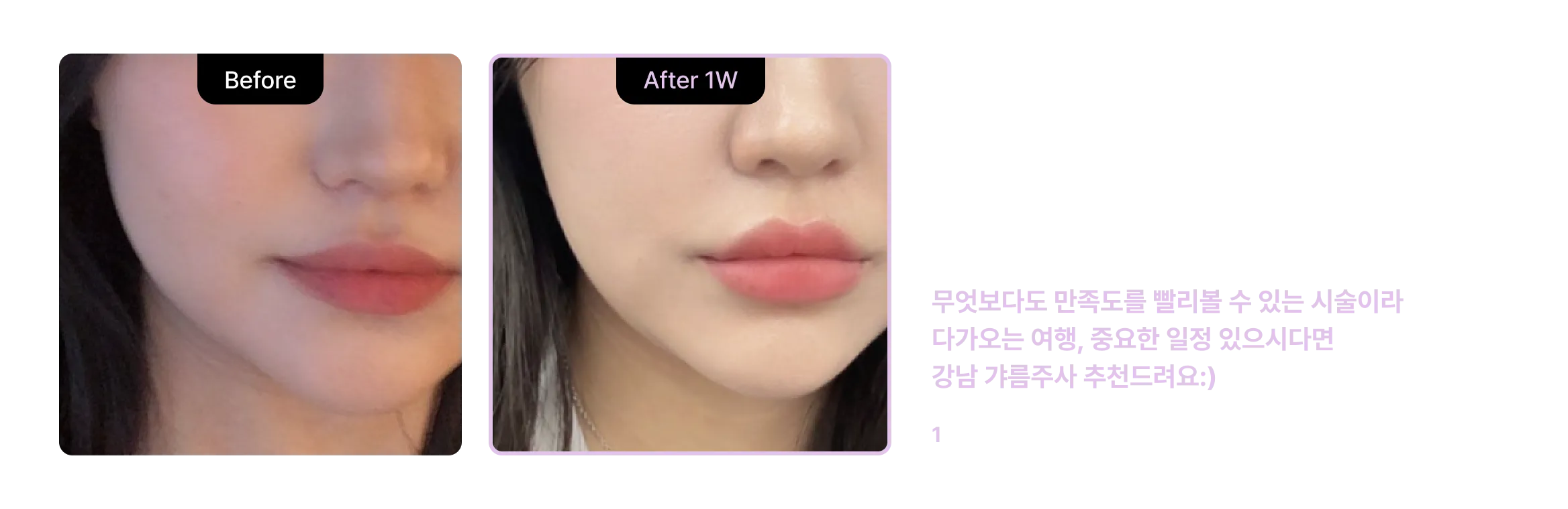 기린성형외과 갸름주사 before, after 후기